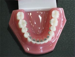 Un modelo de los dientes de una persona con aparatos ortopédicos.