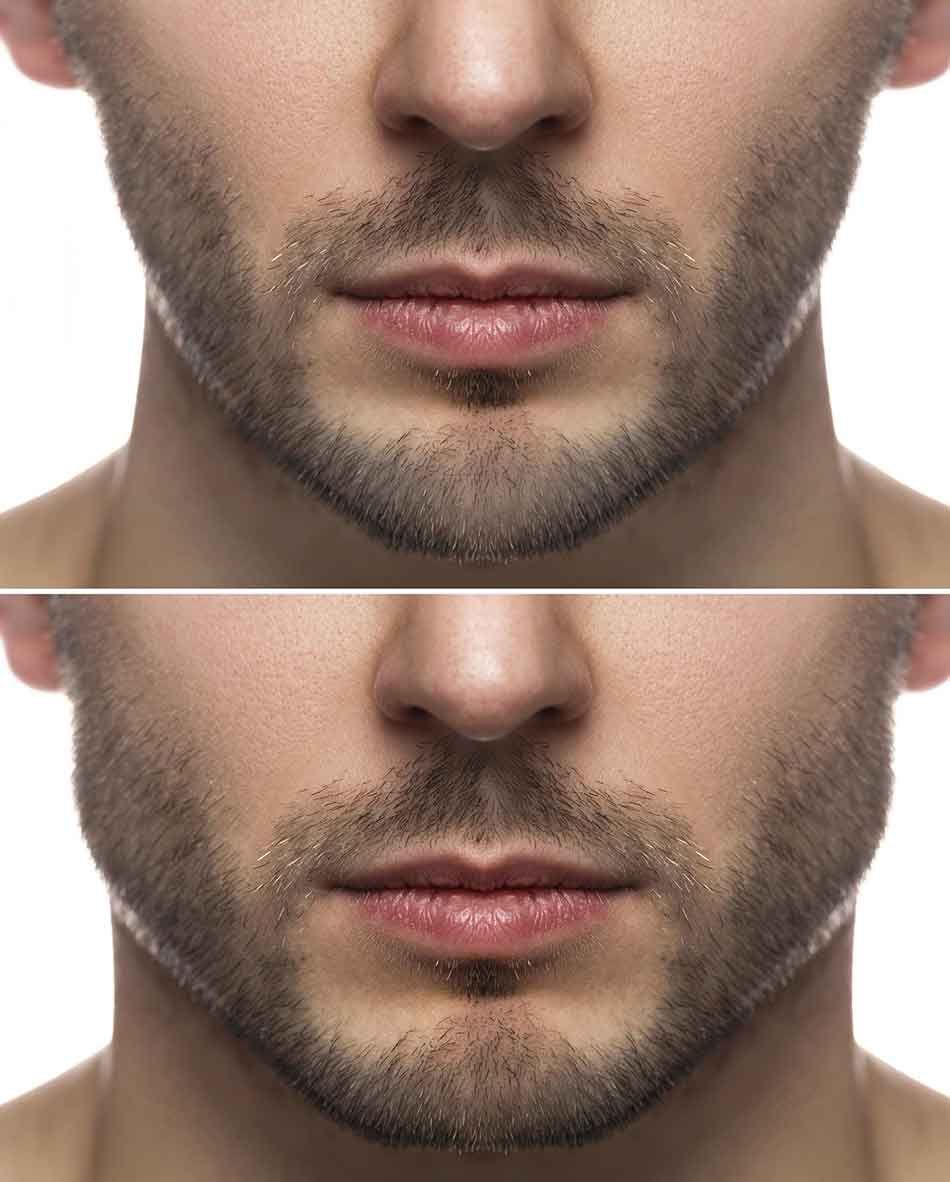 Jawline Hyaluron Mann