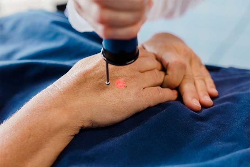Eine Person bekommt eine Laserbehandlung an der Hand.