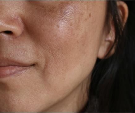 Haut mit Pigmentflecken