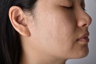 Aknenarben entfernt glatte Haut