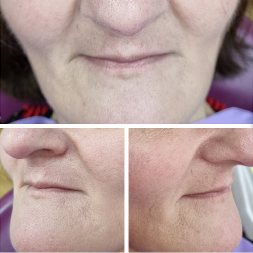 Primer plano de la parte inferior del rostro y el perfil lateral de una persona, mostrando leves líneas de expresión y la textura de la piel.