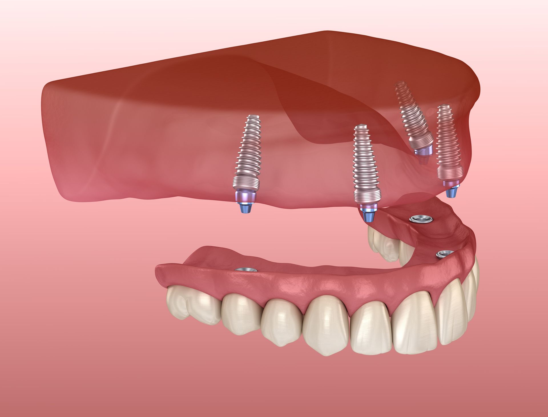 Modelo 3D de implante dental que muestra el hueso maxilar superior, el tejido gingival y los tornillos del implante sobre los dientes.
