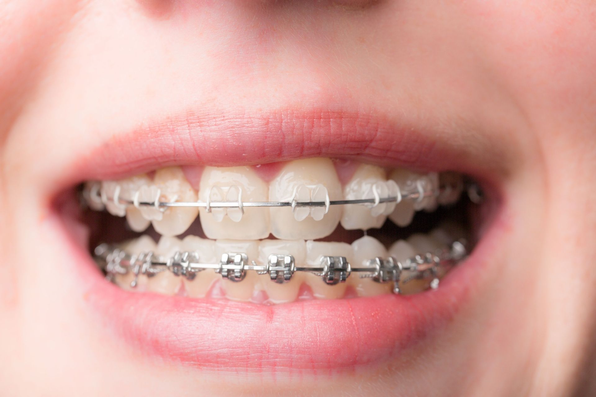 Primer plano de una boca sonriente con brackets transparentes y metálicos en los dientes.