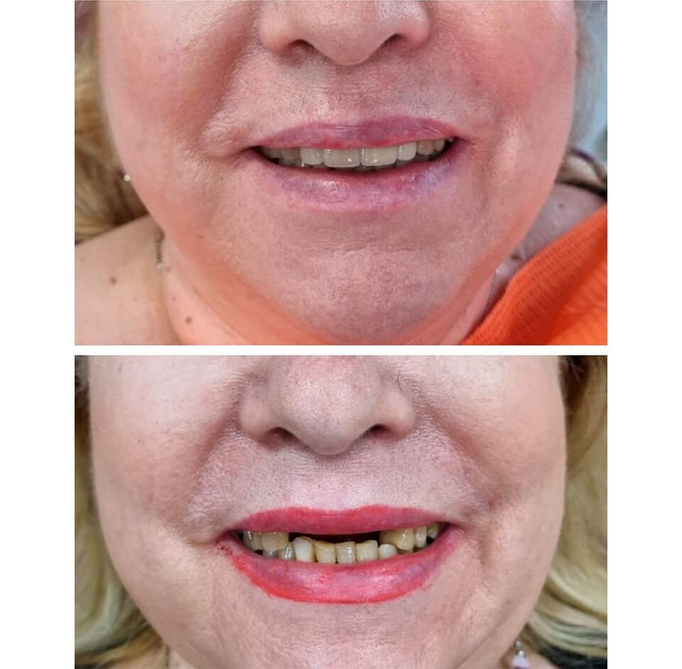 Dos fotografías de la boca en primer plano que muestran los dientes visibles con lápiz labial en el labio inferior.