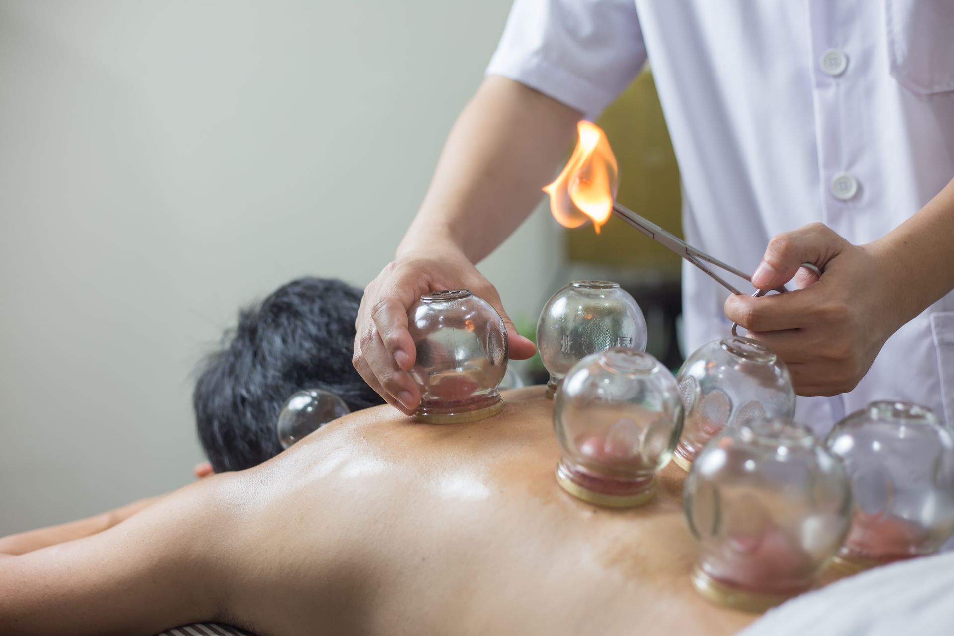 Ein Therapeut führt eine Feuerschröpftherapie am Rücken einer Person durch, indem er mit einer Flamme einen Unterdruck in Glasbechern erzeugt.