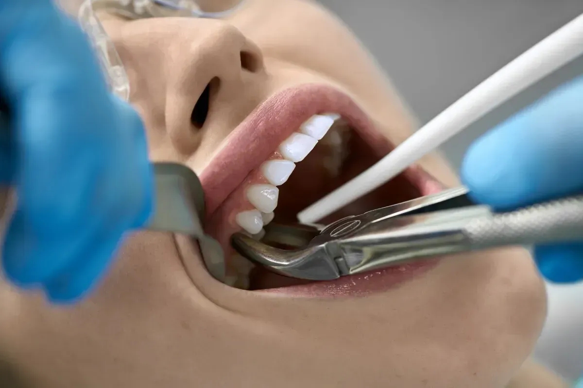 Extracción dental: Boca abierta, herramientas extrayendo un diente, manos enguantadas de azul