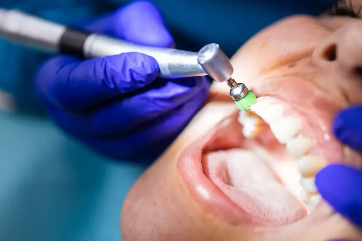 Higienista dental limpiando los dientes con una herramienta de pulido; guantes azules, boca abierta, primer plano.
