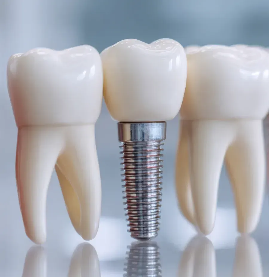 Primer plano de tres dientes modelo. Uno sobre un implante de tornillo de plata; dos adyacentes.