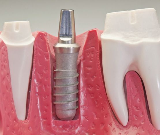Modelo de un implante dental colocado entre dos dientes artificiales, mostrando el implante en forma de tornillo en la encía.