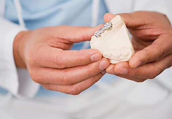 Manos sosteniendo un molde dental con una dentadura parcial.