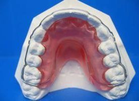 Retenedor transparente, parte interior de color rosa, se ajusta sobre los dientes superiores, en un molde de yeso blanco, sobre fondo azul.