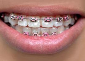 Primer plano de una boca con aparatos metálicos y bandas elásticas rosas en los dientes.