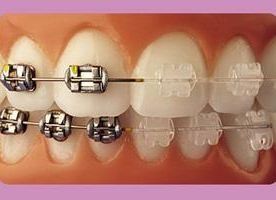 Primer plano de dientes con brackets metálicos y transparentes, mostrando el tratamiento de ortodoncia.