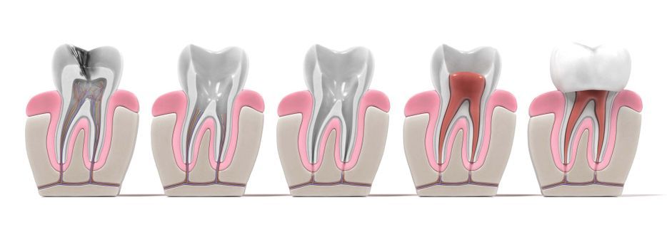 Zähne - kranke Wurzel - Endodontie