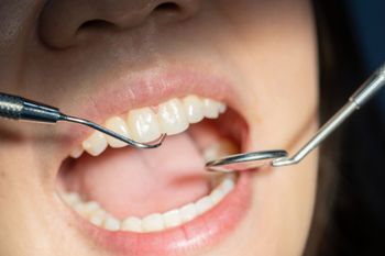Herramientas dentales en la boca de un paciente: espejo y gancho inspeccionando los dientes.