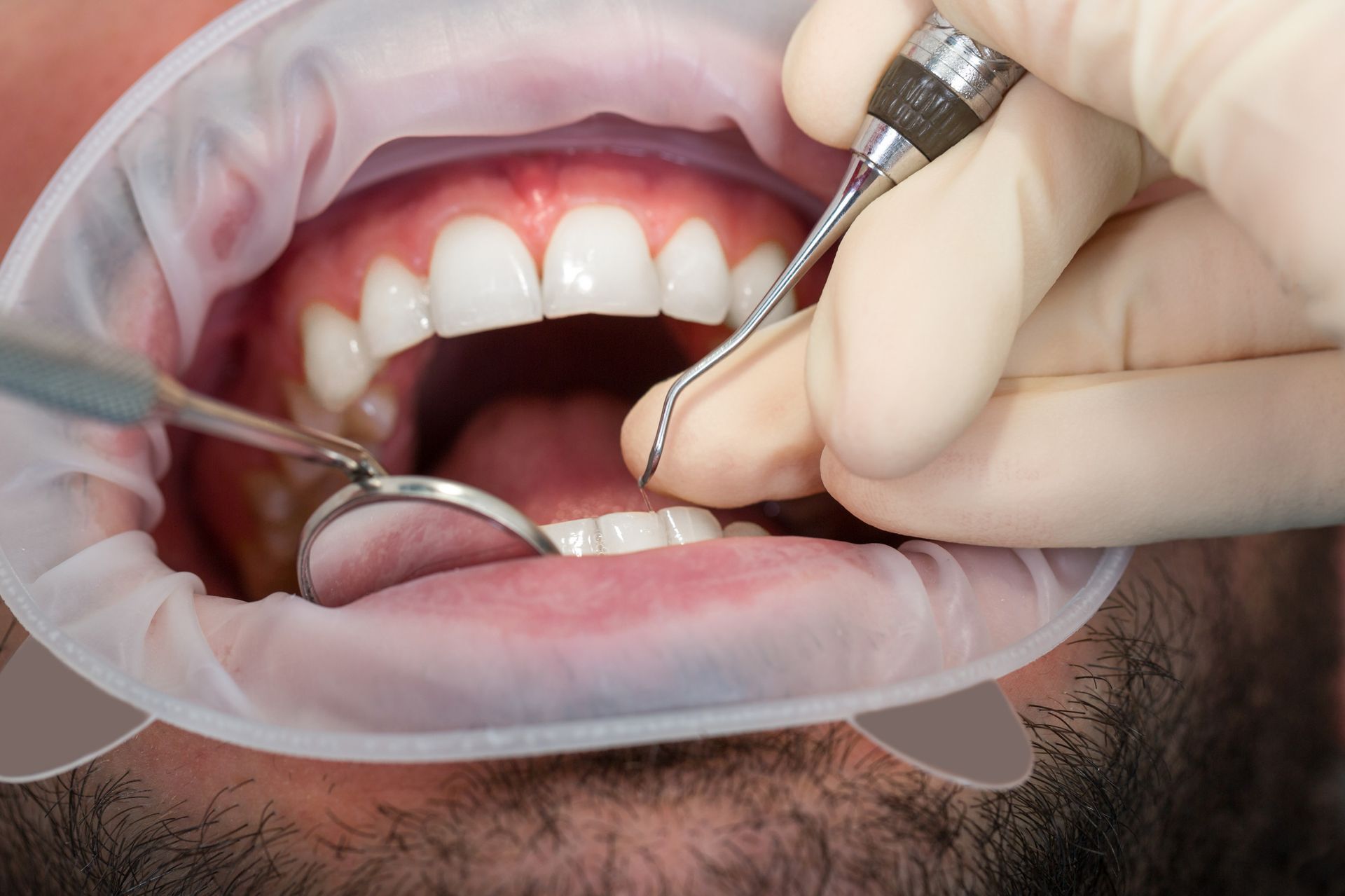Dentista examinando los dientes con un espejo y una sonda en una boca bien abierta.