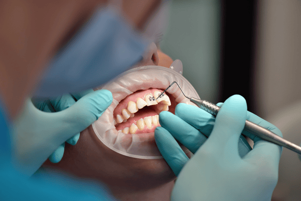 Trabajo dental en progreso; herramientas y manos enguantadas en la boca con dientes, dientes blancos en un dique dental.