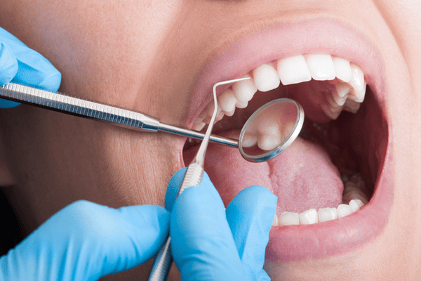 Dentista examinando los dientes con un espejo y una sonda en una boca bien abierta.