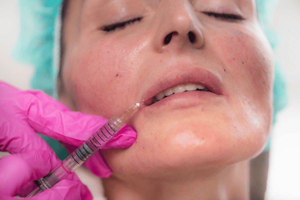 Persona que recibe una inyección de relleno de labios; mano enguantada de color rosa sosteniendo una jeringa cerca de la boca.