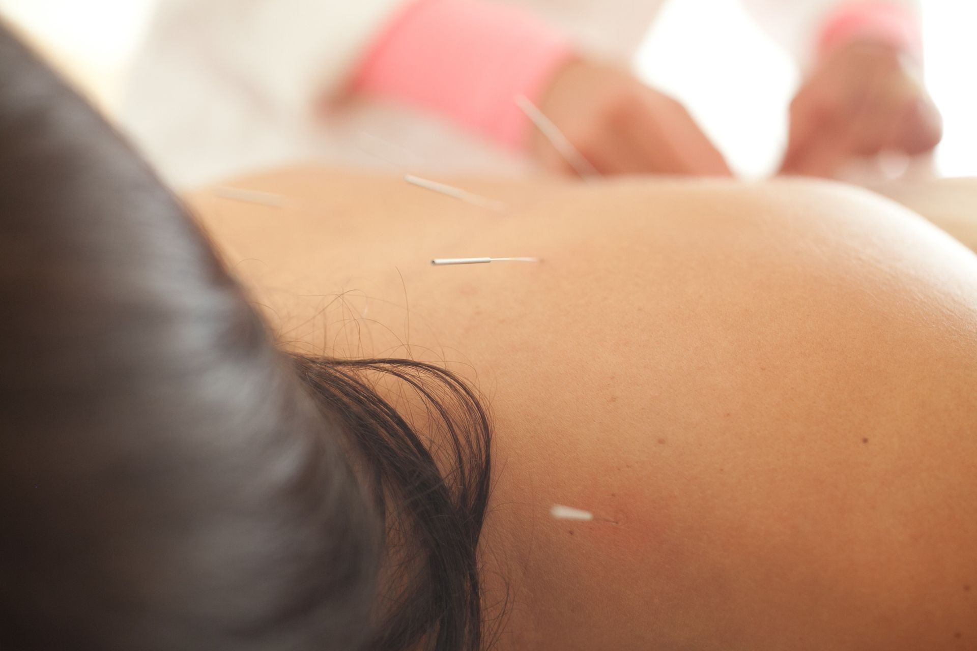 Vista posterior de una persona recibiendo acupuntura. Agujas de acupuntura insertadas en la piel; las manos al fondo.