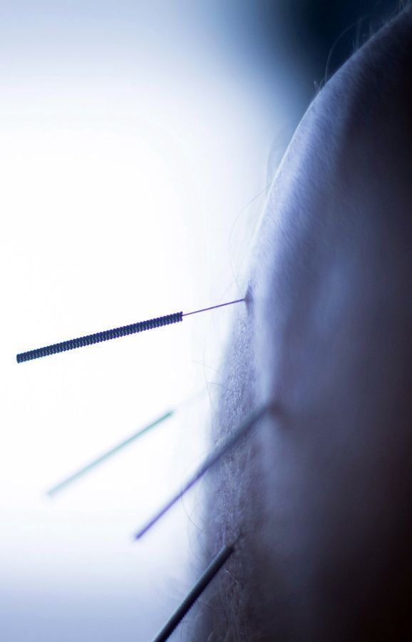 El hombro de una persona con agujas de acupuntura insertadas. Las agujas son de color gris plateado. Fondo brillante y borroso.