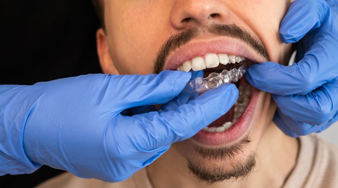 Manos con guantes azules colocando un alineador dental transparente en la boca de una persona.