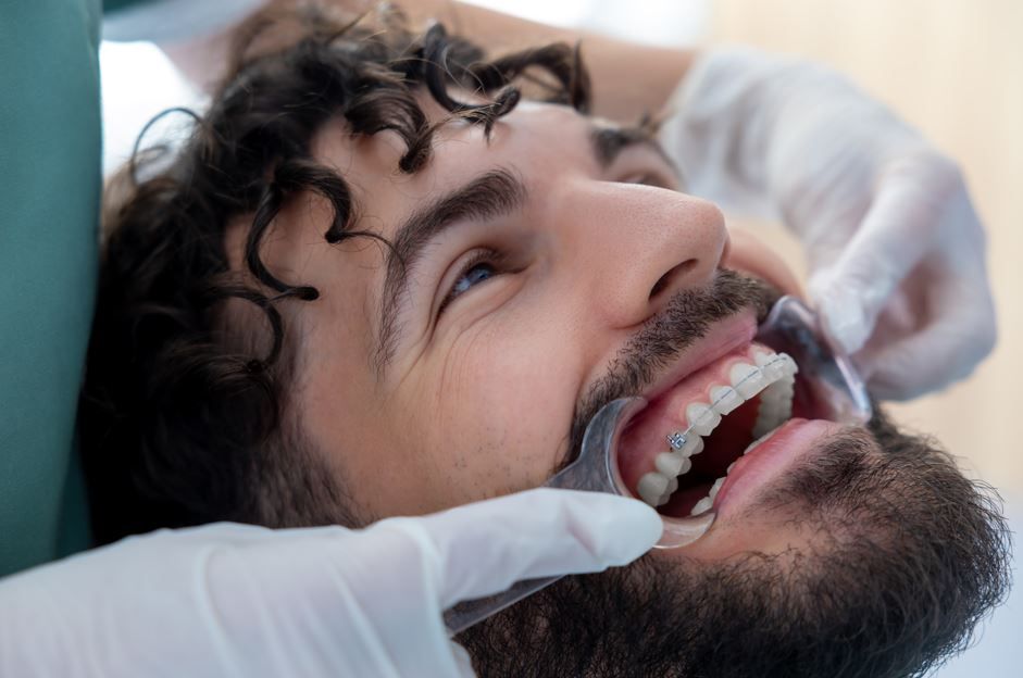 Hombre con la boca abierta en el dentista; herramientas dentales visibles, usando un retractor bucal.