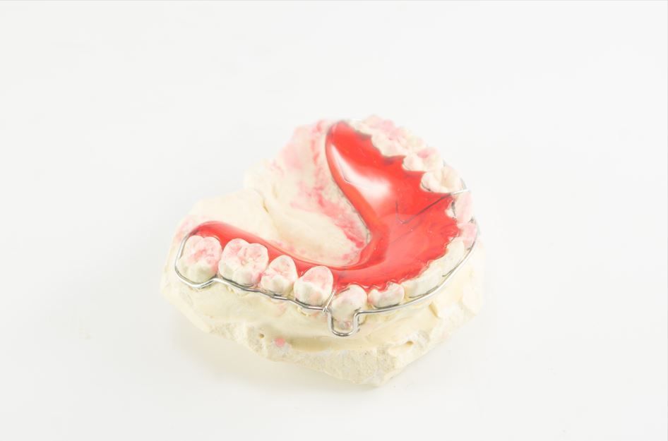 Molde dental con cera roja y retenedor metálico, sobre fondo blanco.