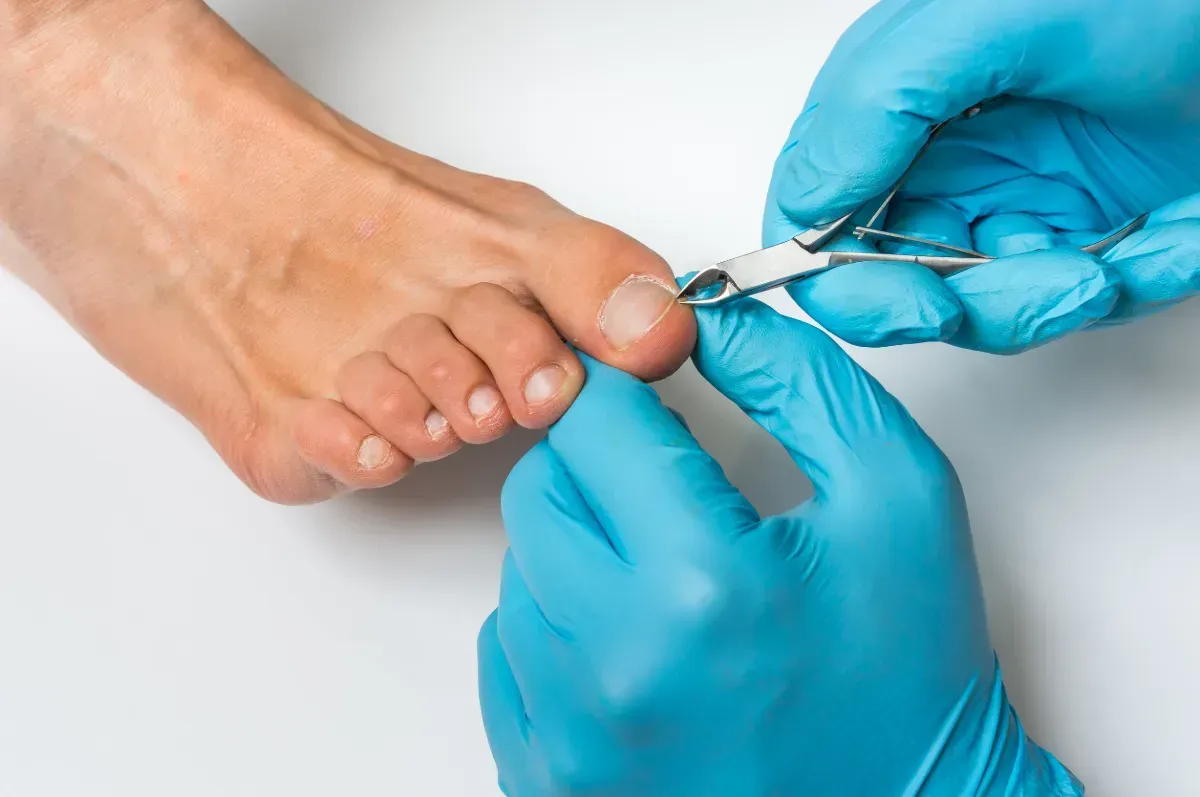 A una persona le están cortando las uñas de los pies mediante un médico.