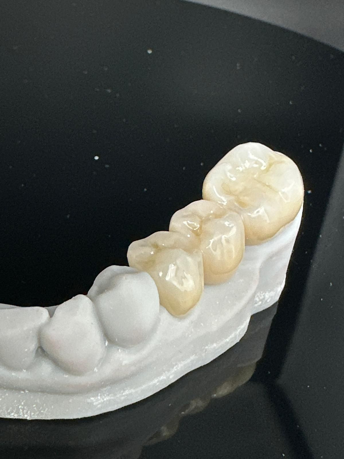 Un modelo dental que muestra una prótesis superior completa colocada sobre un molde inferior en una superficie reflectante.
