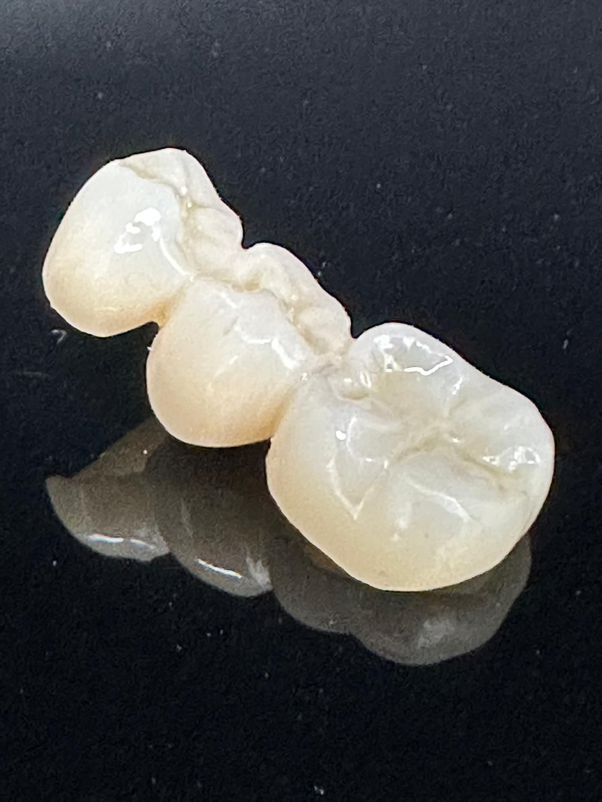 Dos puentes de implantes dentales 