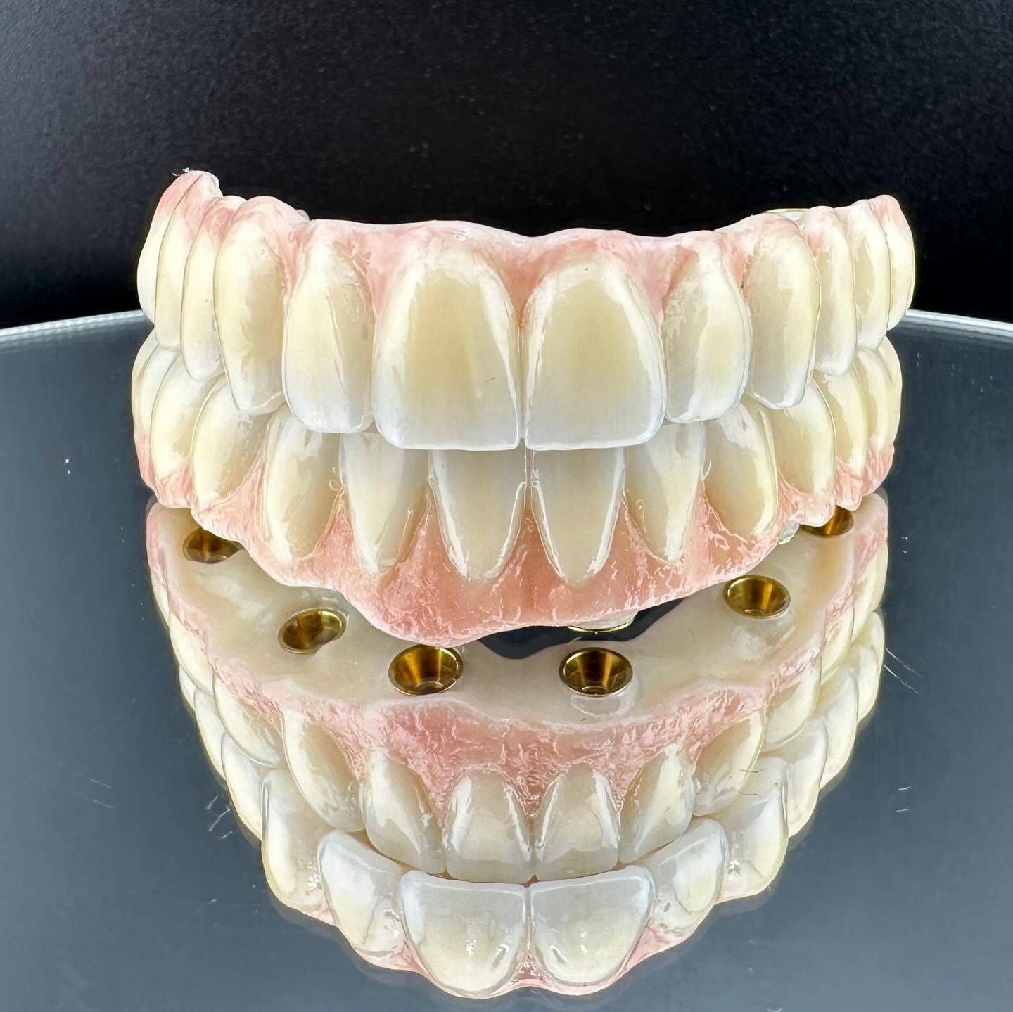 Un puente de implantes dentales