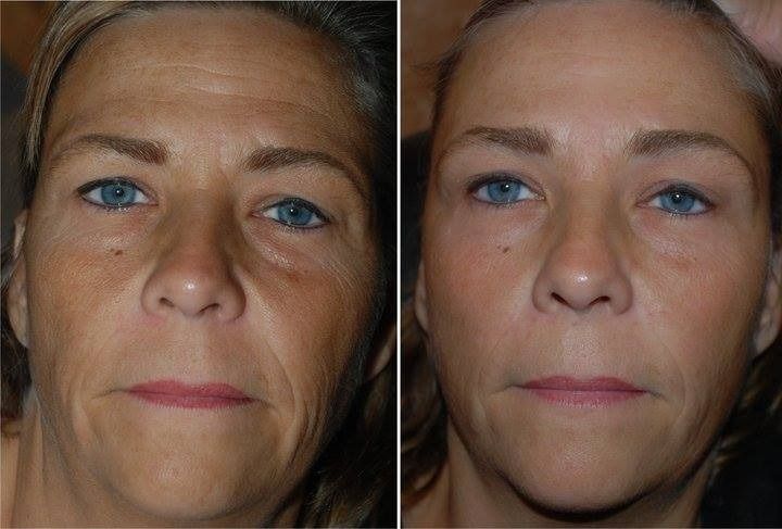 Retratos en primer plano, uno al lado del otro, del rostro de una mujer, que muestran el antes y el después del alisado de la piel.