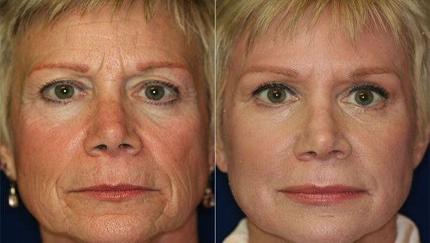 Comparación de retratos lado a lado de la misma mujer con un aspecto más envejecido a la izquierda y una piel más tersa a la derecha.