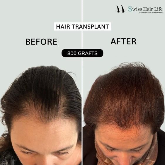 Vorher-Nachher-Ansicht des Kopfes einer Person mit den Ergebnissen einer Haartransplantation. Dunkles Haar, vorher dünn, nach 800 Transplantaten voller.