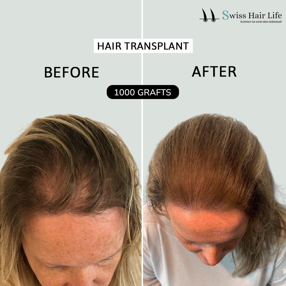 Vorher-Nachher-Ansicht einer Haartransplantation, die eine Frau mit erhöhter Haardichte nach 1000 Transplantaten zeigt.