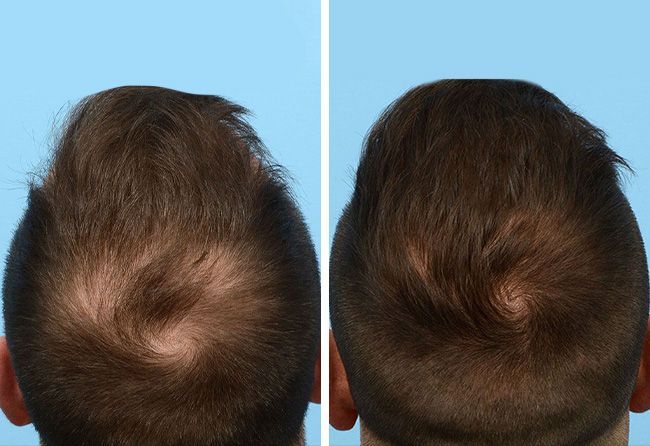 Vorher- und Nachher-Ansichten der Kopfhaut eines Mannes, die den Haarausfall vor und das verstärkte Haarwachstum nach der Behandlung zeigen.