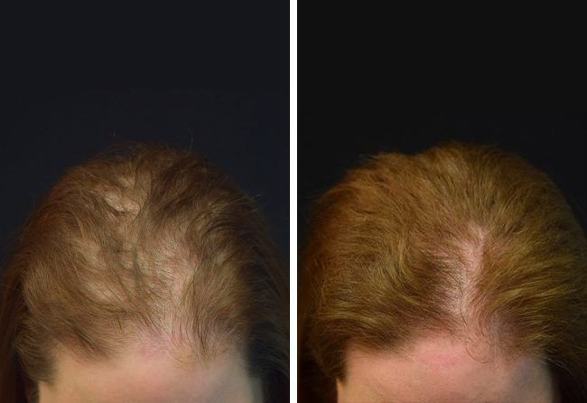 Vorher-Nachher-Vergleich des Haarwachstums einer Frau. Es sind dünner werdendes Haar und dichterer Wuchs zu erkennen, wobei weniger Kopfhaut sichtbar ist.