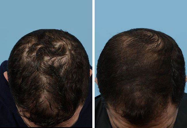 Vorher-Nachher-Vergleich der Kopfhaut eines Mannes, der Haarausfall vor und verstärktes Haarwachstum nach der Behandlung zeigt.