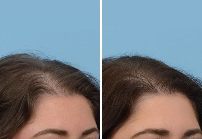 Vergleich des dünner werdenden Haars einer Frau vor und nach der Behandlung. Zeigt eine verbesserte Haardichte und -bedeckung.