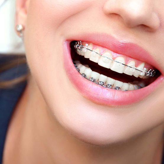 EE Orthodontics SA - Docteur Erdogan - Traitement dentaire enfants