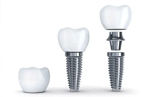 Muestra las etapas de la instalación de un implante dental.