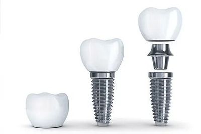 Muestra las etapas de la instalación de un implante dental.