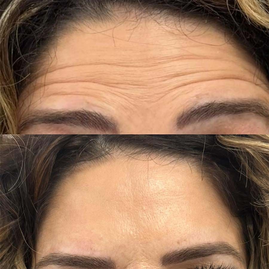 Arrugas de la frente antes y después del tratamiento, mostrando efecto suavizante.