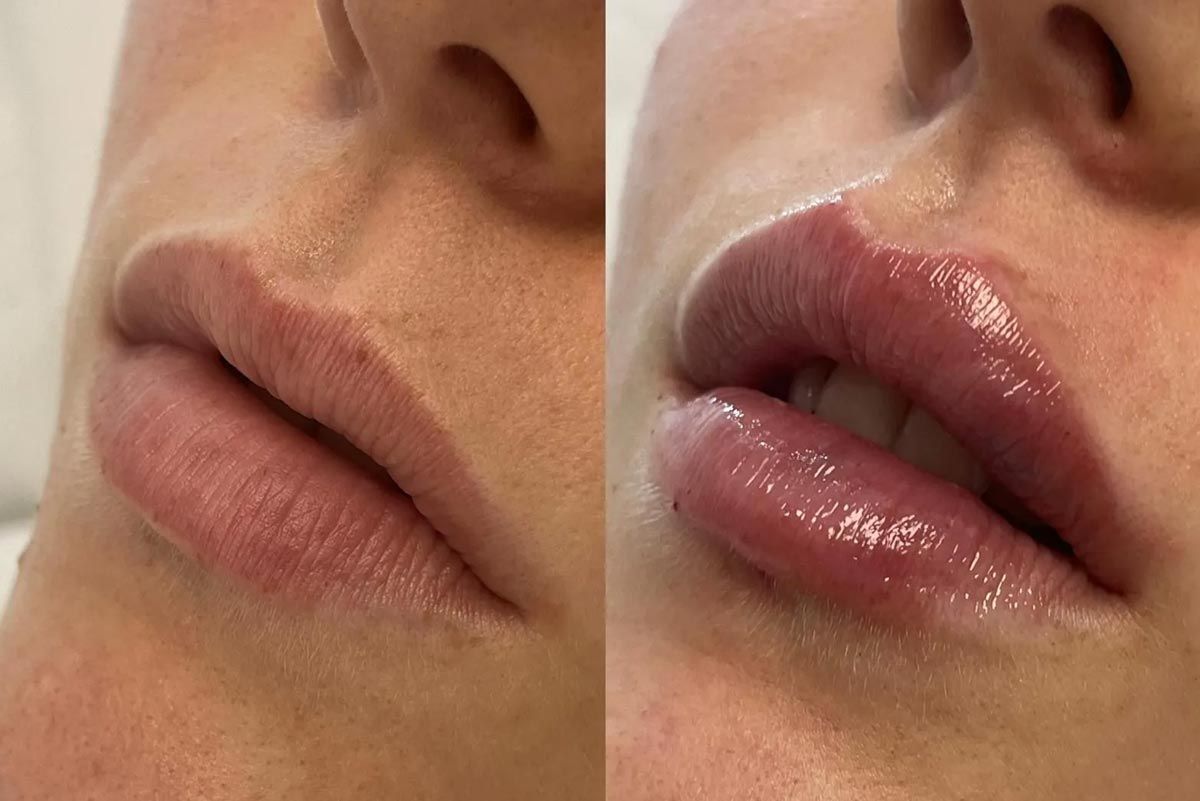 Antes y después de los labios. Izquierda: labios finos y pálidos. Derecha: labios carnosos, brillantes y rosados.