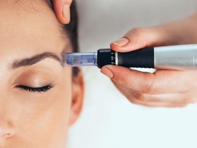 Persona que recibe tratamiento de microagujas en la frente; primer plano del dispositivo en uso.