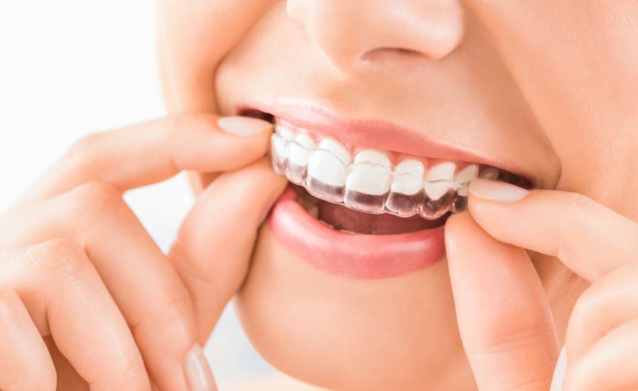Invisalign Schiene
