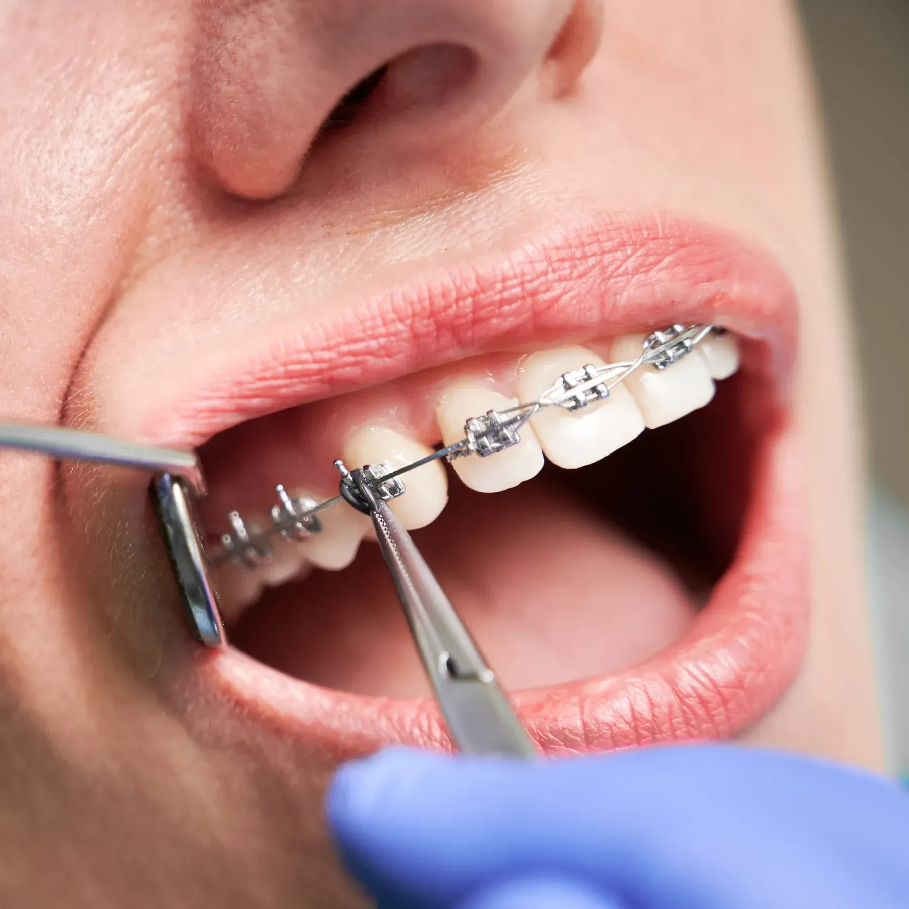 Un profesional dental, con guantes azules, utiliza herramientas metálicas para ajustar el alambre
