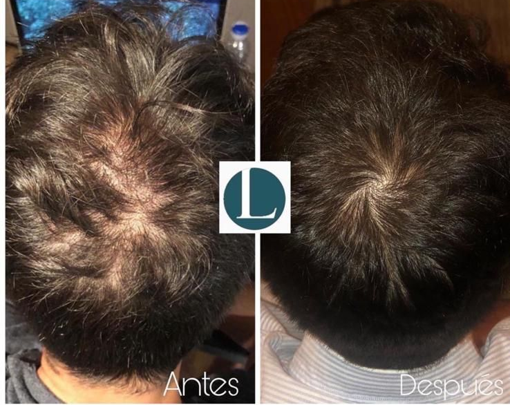 Unas manos enguantadas usan una aguja para examinar de cerca el cuero cabelludo y la línea del cabello de una persona.